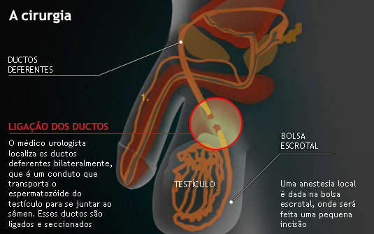 Vasectomia - Clínica de Urologia DK Urologistas Associados