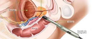 biopsia prostata tyanshi despre prostatita